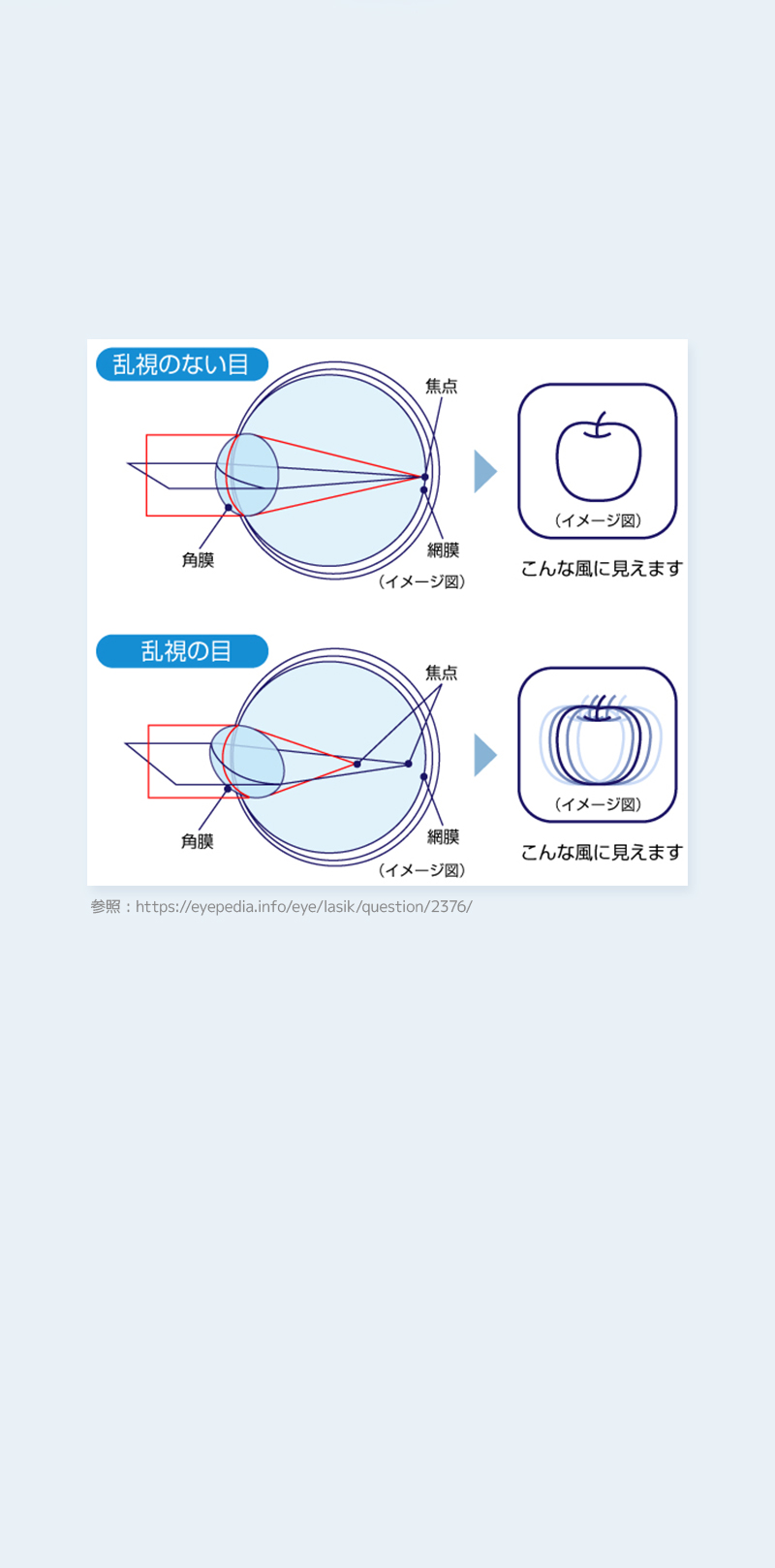 乱視レンズ